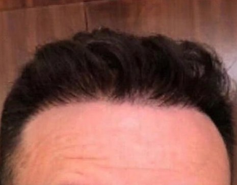Hair · receding hairline, after