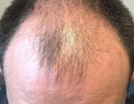 Hair · receding hairline, before