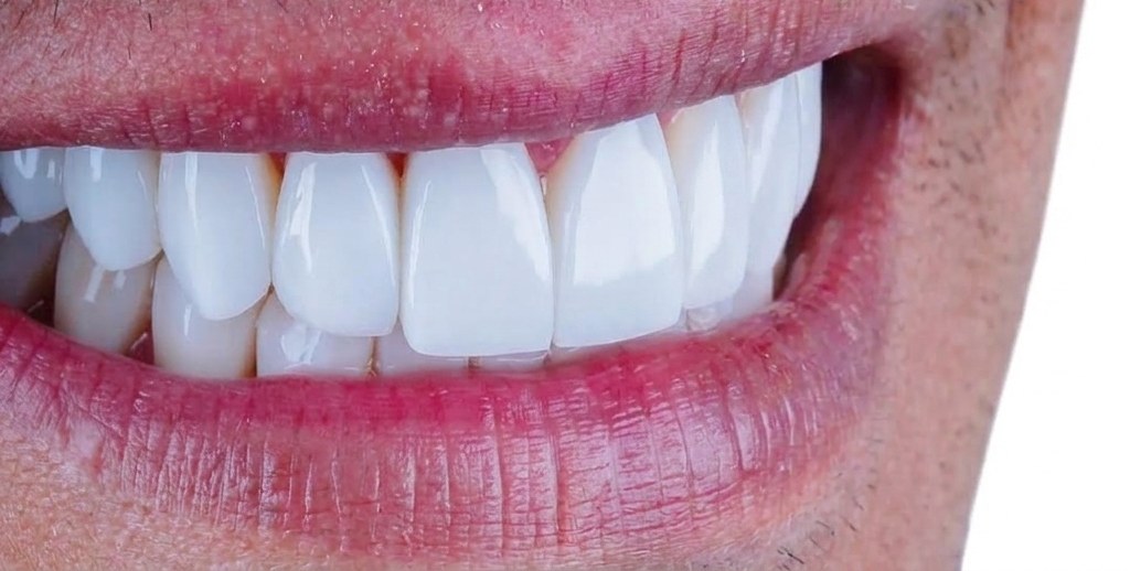 Dental · smile makeover, after